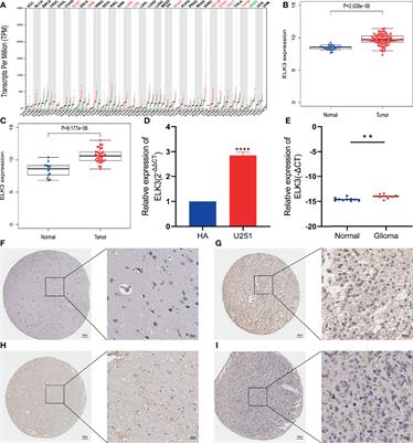 ELK3: A New Molecular Marker for the Diagnosis and Prognosis of Glioma